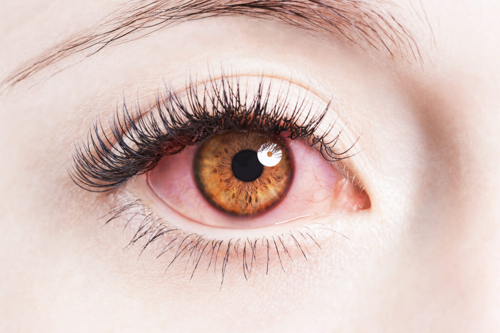 ojo rojo por alergia ocular