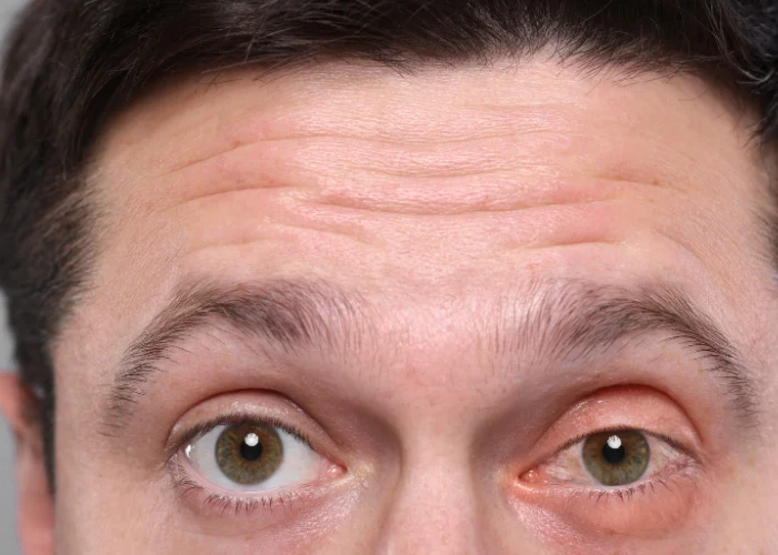 Primer plano de los ojos de una persona donde se aprecia una clara irritación por conjuntivitis en el ojo derecho, el cual luce enrojecido e hinchado. La imagen sirve para ilustrar los riesgos de usar lentillas durante una infección ocular y la importancia de la higiene visual.