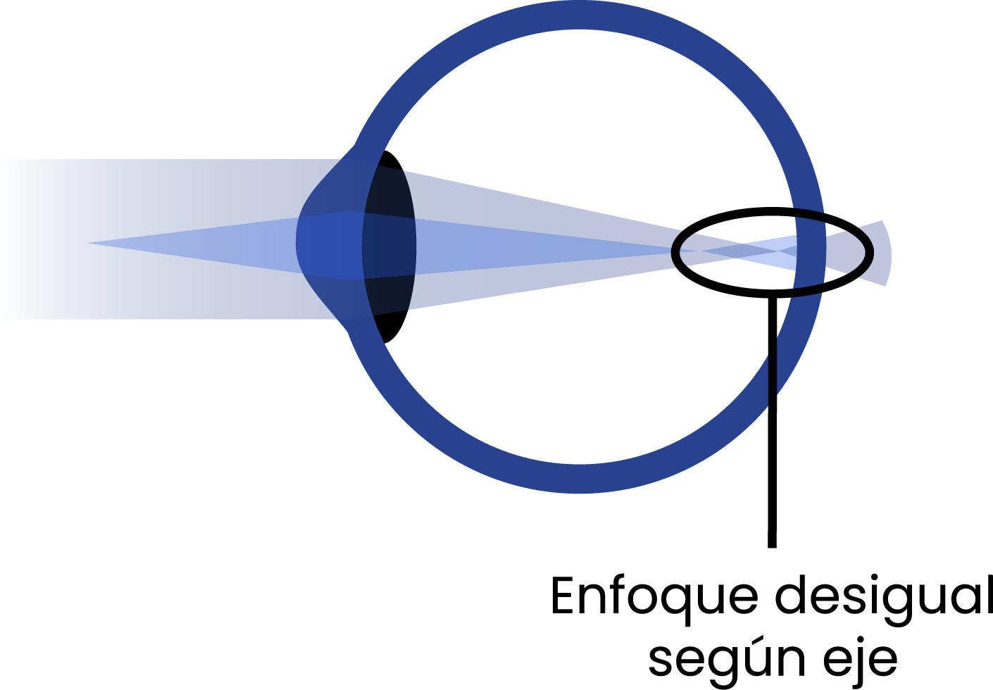 Esquema de ojo con astigmatismo