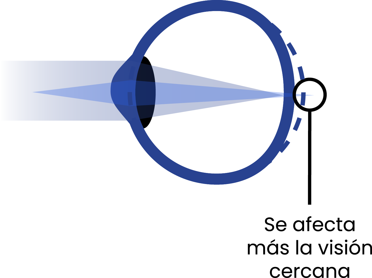 Esquema de ojo con hipermetropía