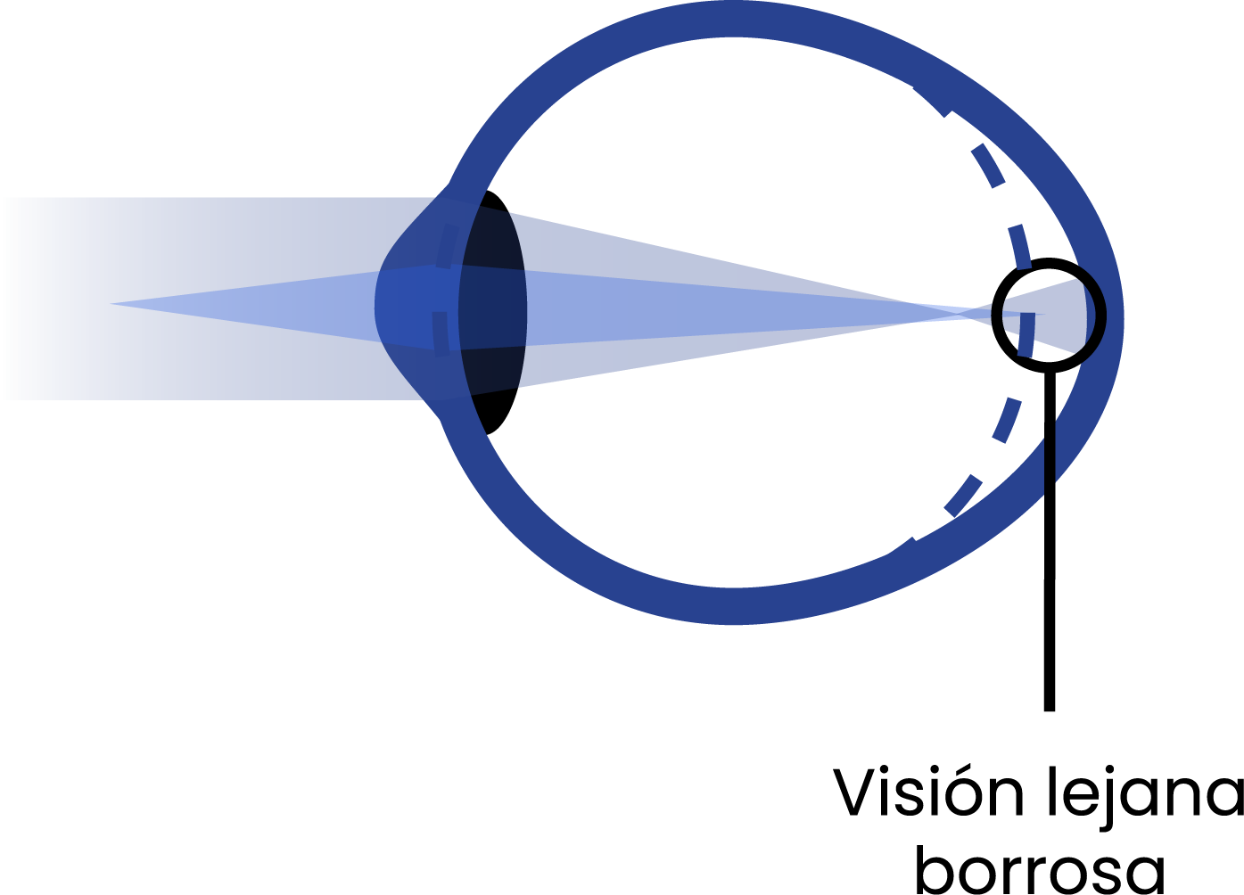 Esquema de ojo con miopía